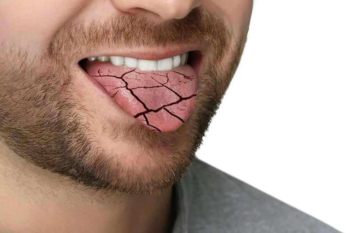 کمبود کدام ویتامین باعث خشکی دهان میشود؟-پارسی پودر مجله علمی تغذیه و سلامت